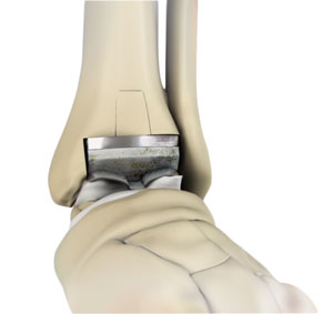 Revision Foot & Ankle Surgery