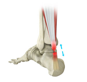 Achilles Tendon Repair