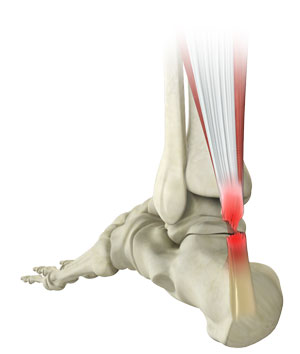 Achilles Tendon Rupture & Degeneration