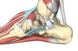 Ankle Ligament Reconstruction