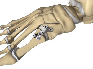 Foot & Ankle Deformity Correction