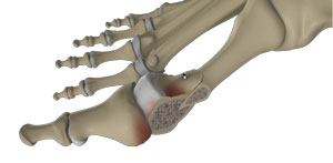 Foot & Ankle Osteotomy