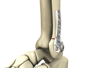Internal & External Fixation of Foot & Ankle Fractures