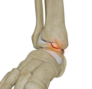Osteochondral Lesions of the Ankle
