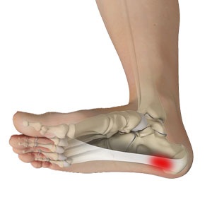 Plantar Fasciitis