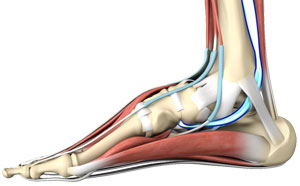 Posterior Tibial Tendon Dysfunction