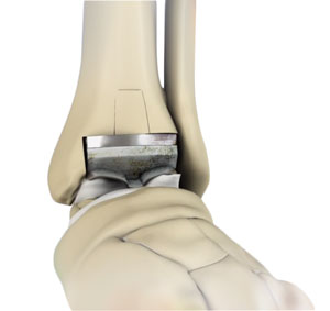 Revision Foot and Ankle Surgery